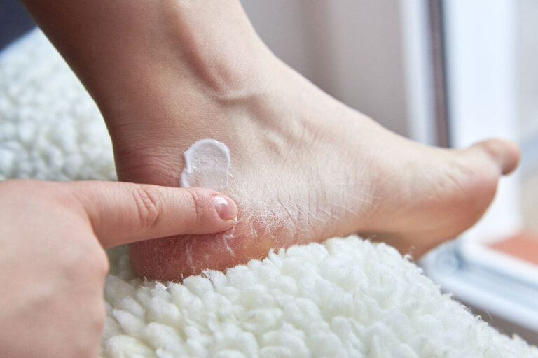 crème pour mycose des pieds